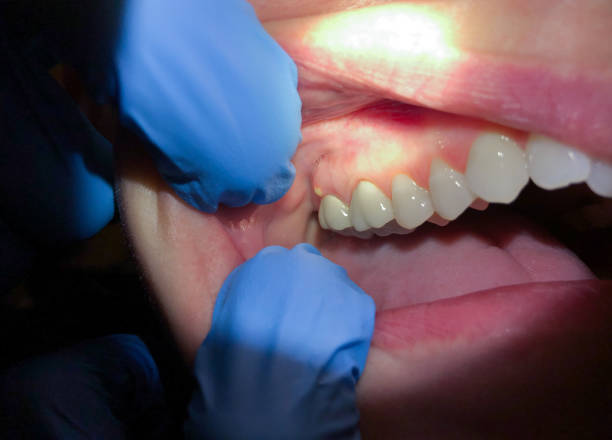 Best Emergency Broken Tooth Repair in St Bernard, OH