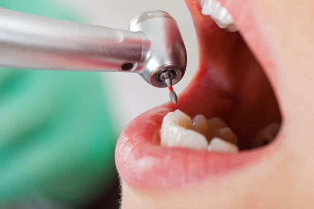 Best Emergency Tooth Extraction in St Bernard, OH